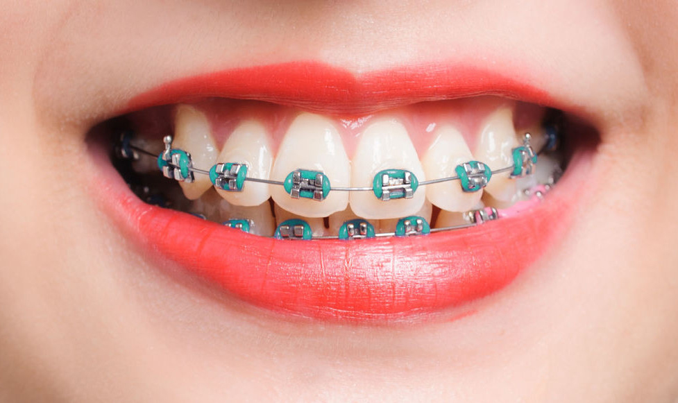 Brace Yourself: A Quick Guide to Braces in Singapore - itechfy